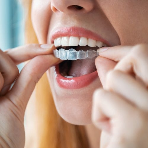 Leistung-CMD-Schienentherapie